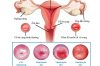 Viêm lộ tuyến cổ tử cung nguyên nhân tiềm ẩn gây ung thư