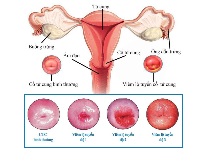 Viêm lộ tuyến cổ tử cung nguyên nhân tiềm ẩn gây ung thư