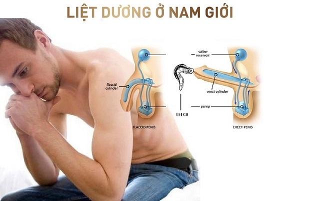Tìm hiểu bệnh lý liệt dương – Nguyên nhân và cách điều trị dứt điểm