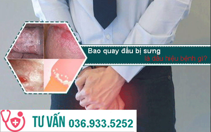 Bao quy đầu bị sưng là dấu hiệu của bệnh gì?